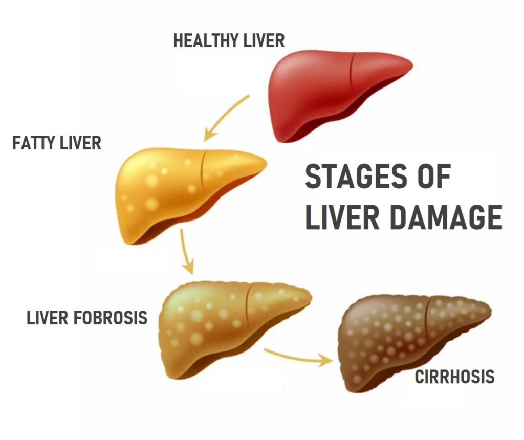 NON-ALCOHOLIC FATTY LIVER DISEASE – WHY YOU SHOULD KNOW MORE ABOUT IT